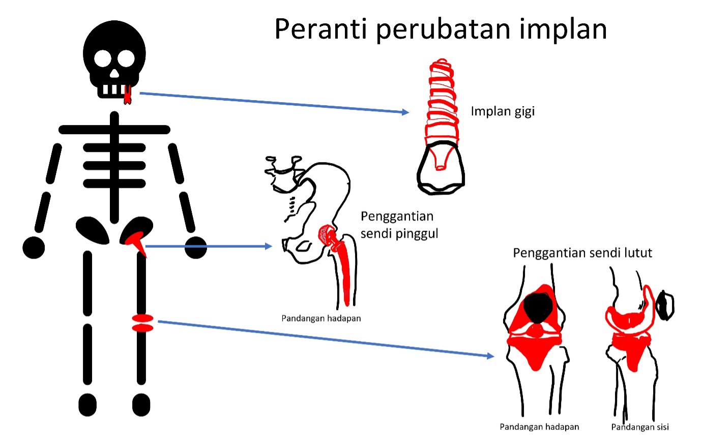 contoh peranti perubatan